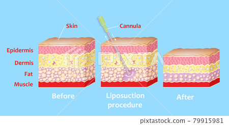 Mechanism of liposuction. Suction-assisted liposuction. 79915981