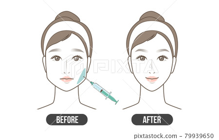 Ella Botox (Simple) 79939650
