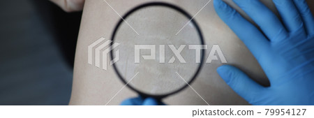 Doctor examining stretch marks on patients back using magnifying glass closeup 79954127