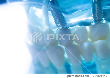 Dental tooth implant Dental tooth implant 79969947