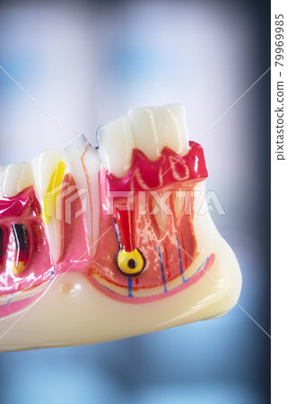 Tooth decay dental model 79969985