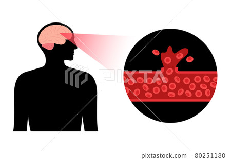 Brain stroke hemorrhagic 80251180