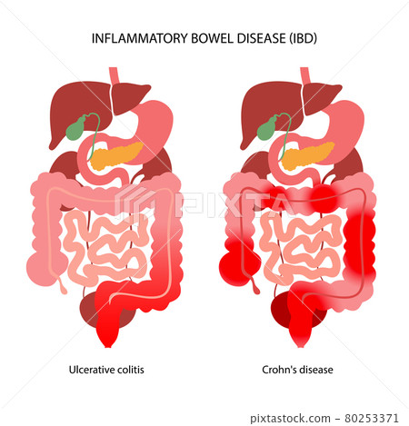 Inflammatory bowel disease 80253371