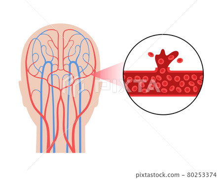 Brain stroke hemorrhagic 80253374