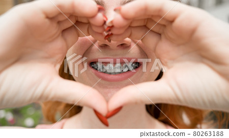 Close-up portrait of a young red-haired woman with braces on her teeth holding her hands in the shape of a heart. Orthodontic appliances for a perfect smile. Close-up portrait of a young red-haired woman with braces on her teeth holding her hands in the shape of a heart. Orthodontic appliances for a perfect smile. 80263188