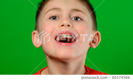 A boy of Caucasian nationality demonstrates a plate for straightening crooked and deformed teeth. 80374566