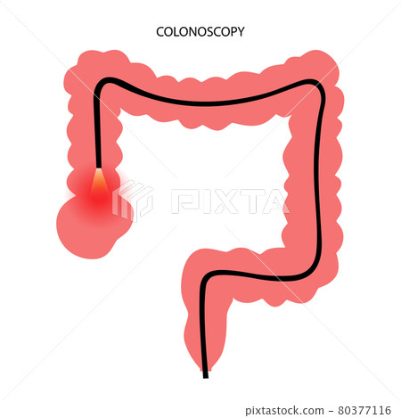 Colonoscopy procedure concept Colonoscopy procedure concept 80377116