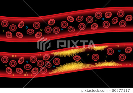 Cholesterol blood artery 80377117