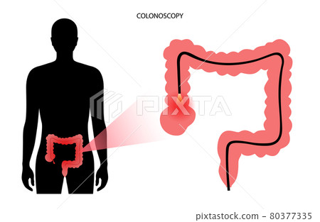 Colonoscopy procedure concept 80377335