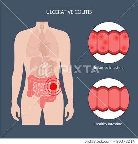 intestine ulcerative colitis 80378214