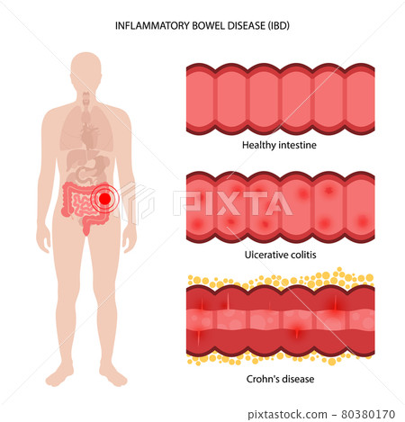Inflammatory bowel disease Inflammatory bowel disease 80380170