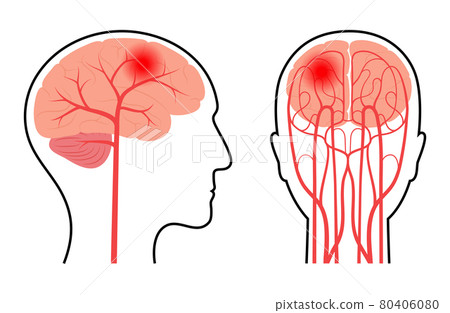 Brain pain disease 80406080