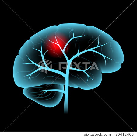 Brain pain disease 80412406