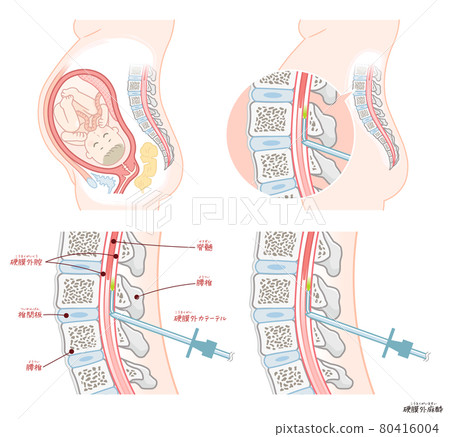Painless delivery / epidural anesthesia 80416004