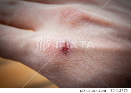 Healing process of wound Healing process of wound 80418775