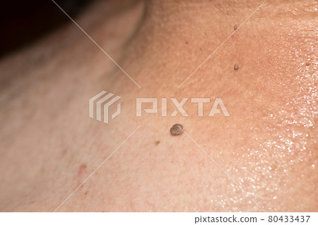 Papilloma located on a man's neck. Papilloma located on a man's neck. 80433437