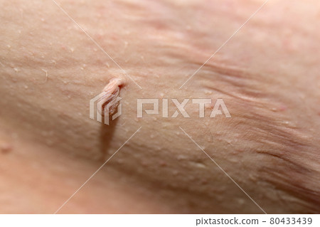 The papilloma is located on the man's abdomen next to the surgical suture. The papilloma is located on the man's abdomen next to the surgical suture. 80433439