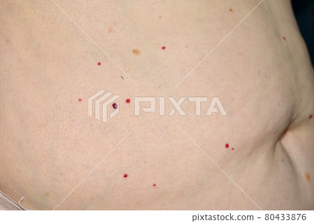 A lot of papillomas on the abdomen of a woman. A lot of papillomas on the abdomen of a woman. 80433876