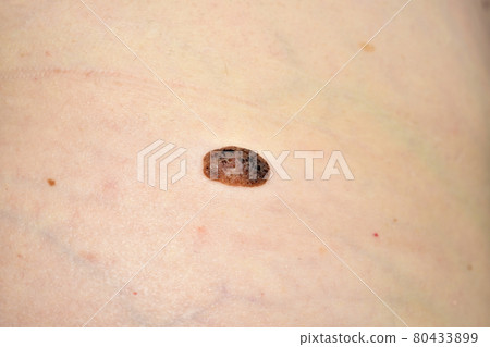 Close-up of a large mole on a woman's side. Close-up of a large mole on a woman's side. 80433899