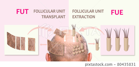 Methods of hair transplantation fut vs fue with infographic elements of illustration. Methods of hair transplantation fut vs fue with infographic elements of illustration. 80435831