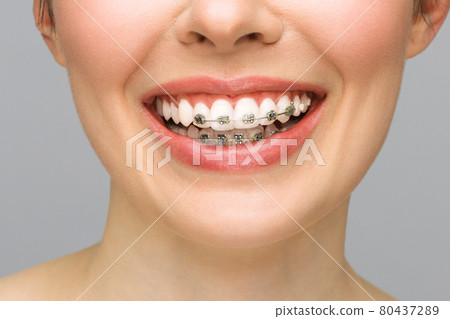 Orthodontic Treatment. Dental Care Concept. Beautiful Woman Healthy Smile close up. Closeup Ceramic and Metal Brackets on Teeth. Beautiful Female Smile with Braces. 80437289