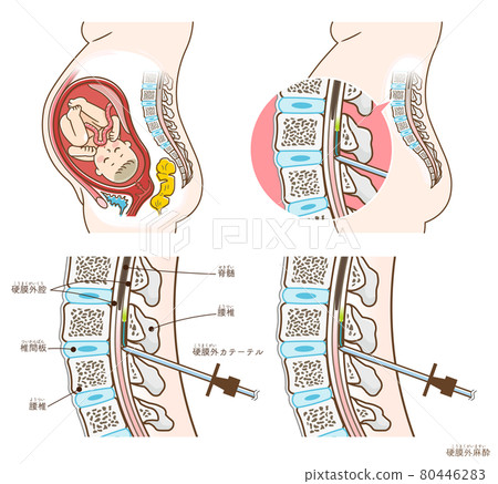 無痛分娩和硬膜外麻醉的插圖 80446283