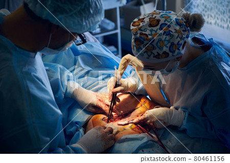 Medical team doing abdominoplasty or tummy tuck surgery in operating room. 80461156
