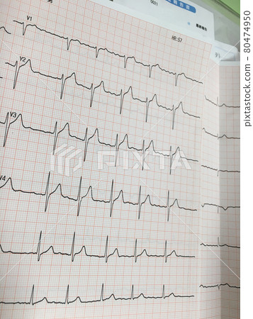 心電圖健康檢查心律失常波形心臟測試 80474950