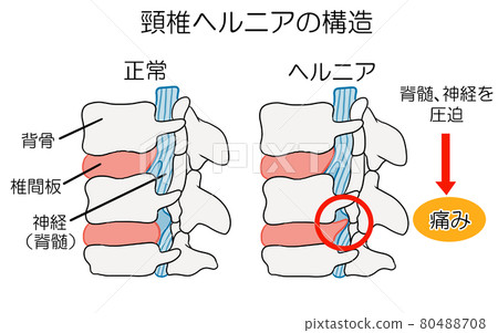 Illustration of cervical disc herniated structure 80488708
