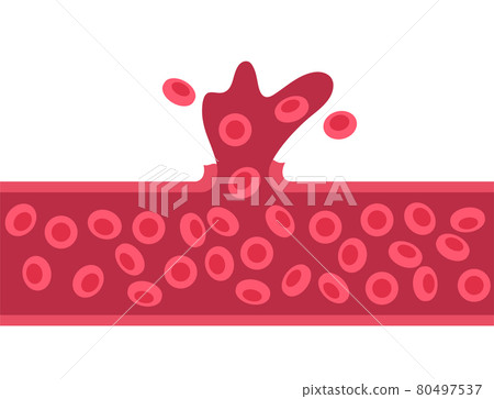 Brain stroke hemorrhagic 80497537