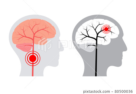 Brain pain disease 80500036