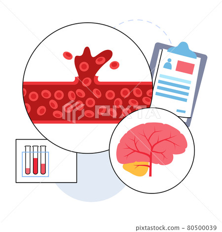 Brain stroke hemorrhagic 80500039