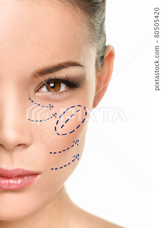 Plastic surgery Asian woman cheekbone augmentation surgical beauty procedure marks drawing on face 80505420