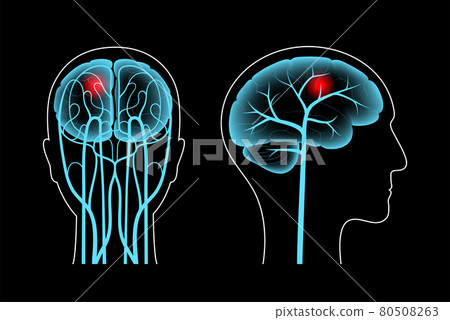 Brain pain disease Brain pain disease 80508263