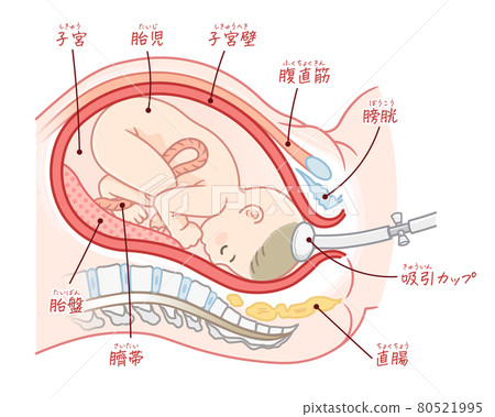 Illustration of a suction-delivered foetation (with text) Illustration of a suction-delivered foetation (with text) 80521995