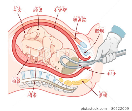 Illustration of a fetal forceps delivery (with... - Stock Illustration  [80522009] - PIXTA