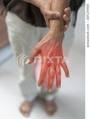Peripheral Neuropathy pain, Guillain-Barre syndrome GBS in elderly patient on hand, finger and sensory nerves with numb, aching, muscle weakness from chronic inflammatory demyelinating polyneuropathy 80529469