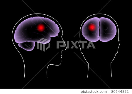 Brain pain disease 80544821