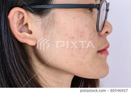 Side view of woman face has variety problems on her skin (such as Acne, Pimple, Pores and Melasma etc). Conceptual of natural problem on woman skin. 80546937