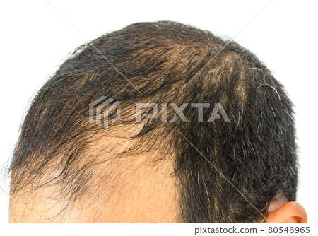 Close up of Male-pattern baldness typically appears first at the hairline or top of the head. It can progress to partial or complete baldness. Close up of Male-pattern baldness typically appears first at the hairline or top of the head. It can progress to partial or complete baldness. 80546965