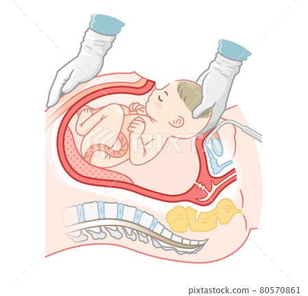 剖腹產嬰兒的插圖 80570861