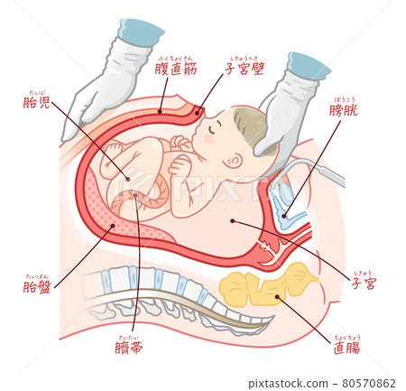 剖腹產嬰兒的插圖（附文字） 80570862