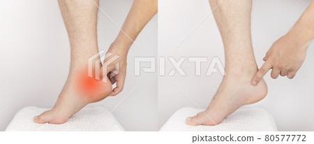 Before and after. On the left, a man holds on to a sore heel that hurts. On the right, the man pain disappeared, and the doctors cured it. Heel spur, muscle strain, tendon injury or microcracks 80577772
