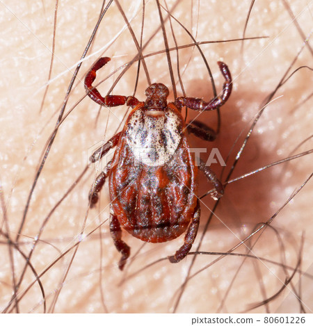 Blood-sucking mite on a human skin macro Blood-sucking mite on a human skin macro 80601226