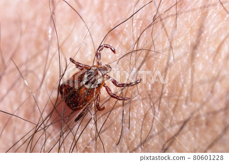 Blood-sucking mite on a human skin macro Blood-sucking mite on a human skin macro 80601228