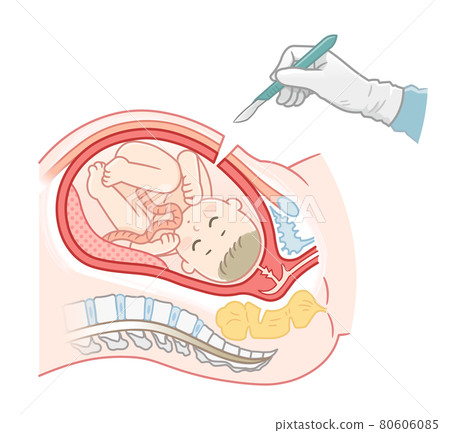 Caesarean section surgery and foetation 80606085