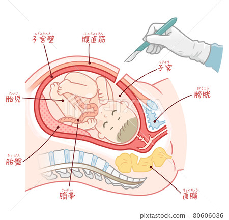 剖腹產手術和胎兒（附文字） 80606086