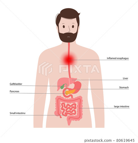 esophageal cancer concept 80619645