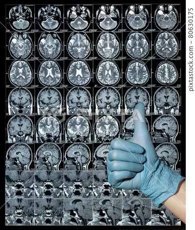MRI brain scan or magnetic resonance image results, thumbs up MRI brain scan or magnetic resonance image results, thumbs up 80630175