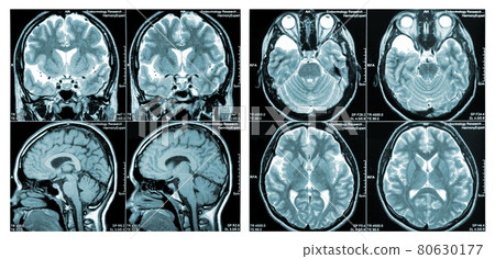 MRI Scan of a human brain showing all main multiple sclerosis 80630177